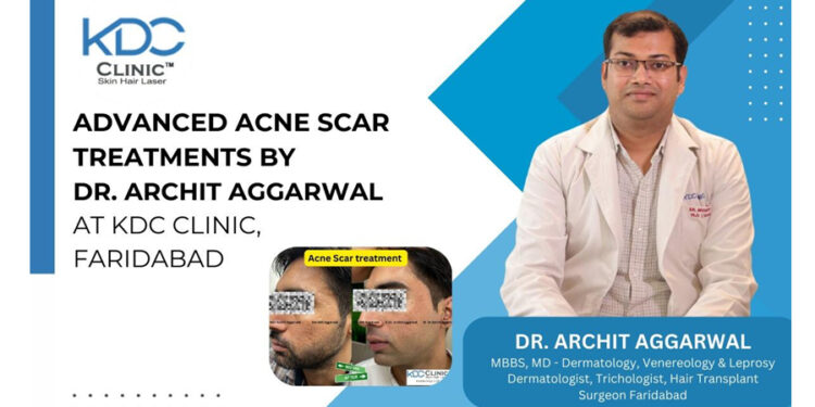 Advanced Acne Scar Treatments by Dr. Archit Aggarwal at KDC Clinic, Faridabad