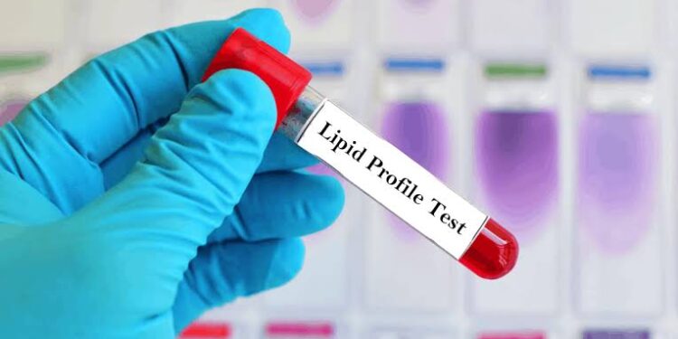 Why Regular Lipid Profile Tests Are Crucial for Heart Health