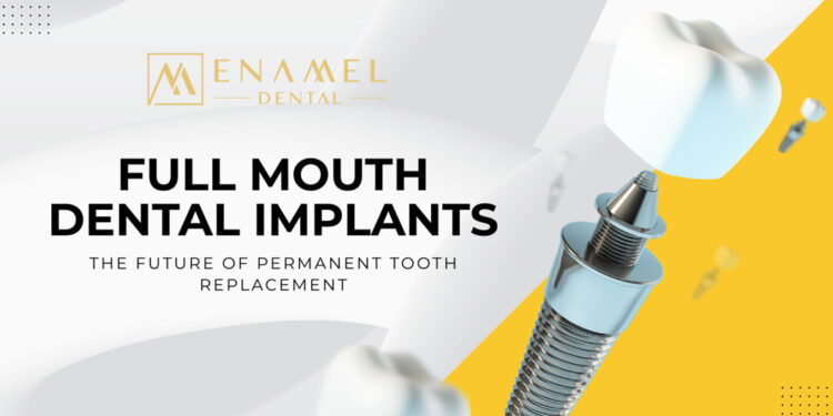 Why Full Mouth Dental Implants Are the Future of Permanent Tooth Replacement